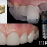 When will I get new teeth?